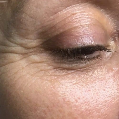 trattamento anti-age brescia occhi
