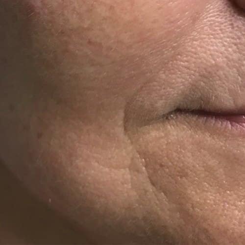 trattamento anti-age brescia labbra